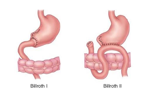 Billroth 1 and 2