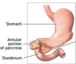 Management of annular pancreas
